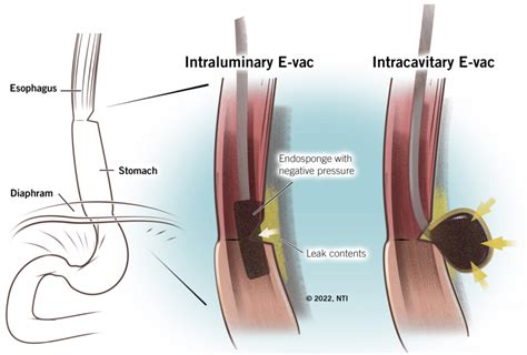 Anastomotic Leak